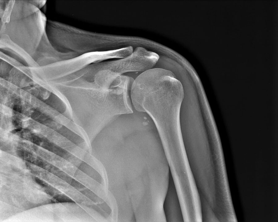Radiographie de l'arthrose de l'articulation de l'épaule du deuxième degré de sévérité. 