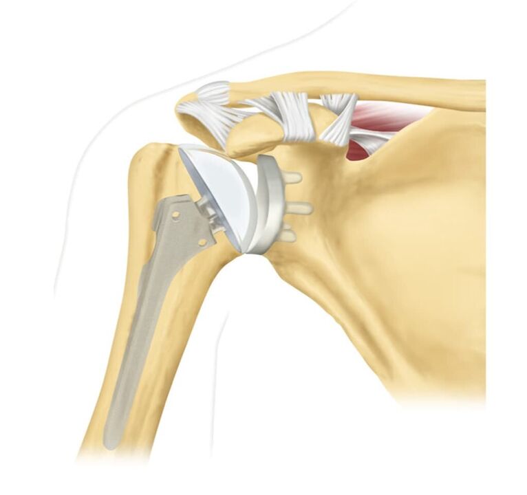 Remplacement d'une articulation de l'épaule endommagée par un stent