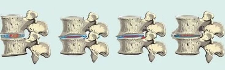 lésion de la colonne vertébrale en cas d'ostéochondrose thoracique