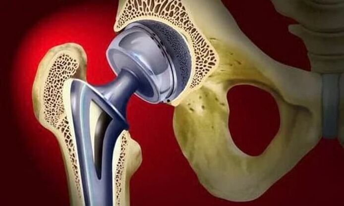 Remplacement de l'articulation de la hanche pour l'arthrose