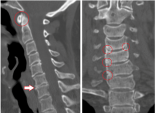 La tomodensitométrie montre des vertèbres endommagées et des disques de hauteur hétérogène dus à une ostéochondrose thoracique. 