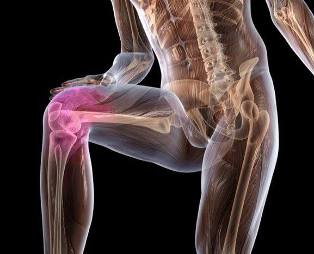 Inflammation de l'articulation du genou avec arthrose. 