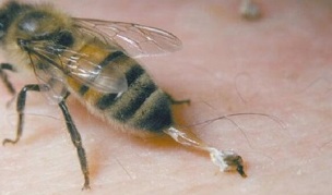 traitement de l'arthrose de la hanche causée par les abeilles