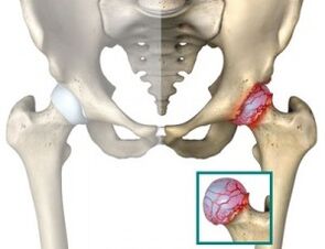 Causes de l'atrose de l'articulation de la hanche.