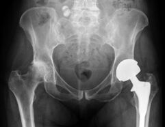 diagnostic d'arthrose de la hanche