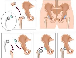 endoprothèses pour l'arthrose de la hanche