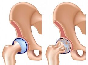 symptômes de l'arthrose de la hanche